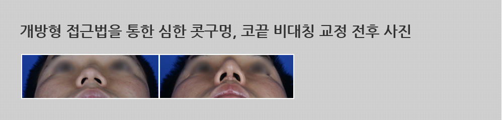 개방형 접근법을 통한 심한 콧구멍, 코끝 비대칭 교정 전후 사진