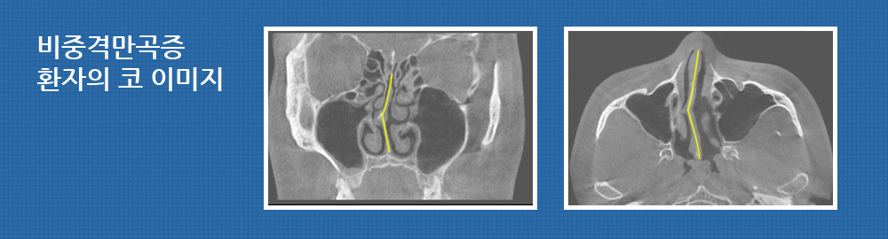 비중격만곡증 환자의 코 이미지