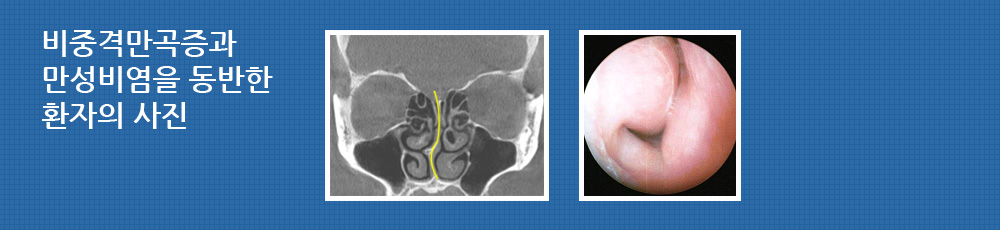 비중격만곡증과 만성비염을 동반한 환자의 사진